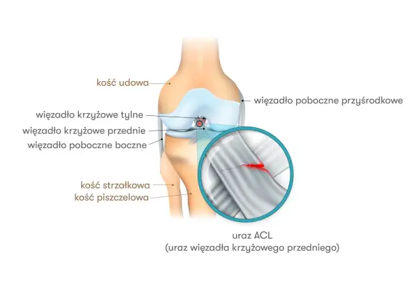 Uraz ACL kolana - Jak rozpoznać, leczyć i wrócić do sportu?